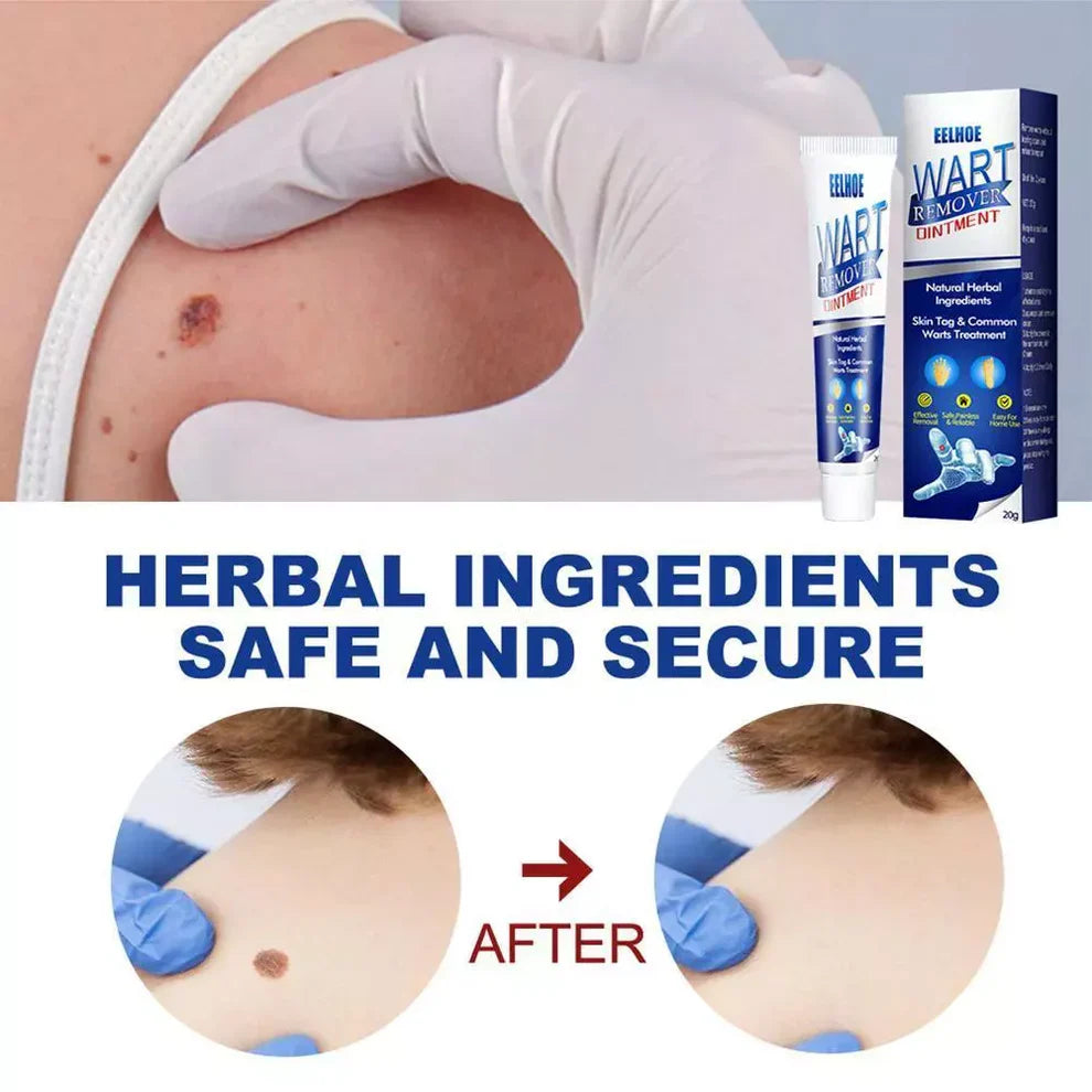 Wart Remover Cream – Fast & Effective