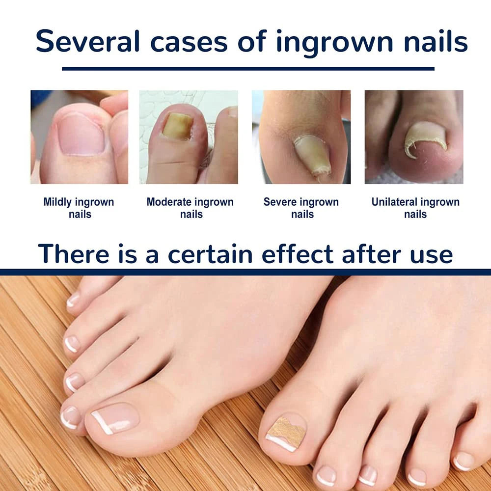Correction patches for beautiful and healthy nails