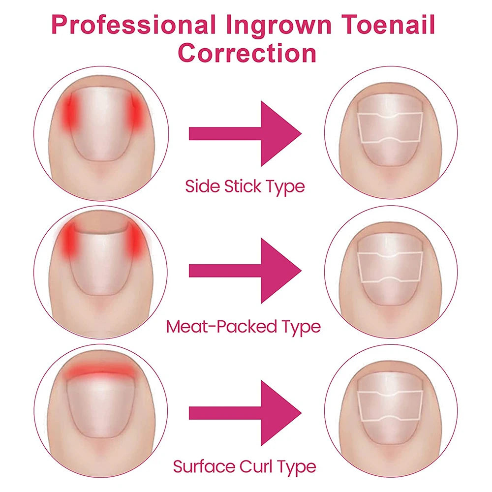 Correction patches for beautiful and healthy nails