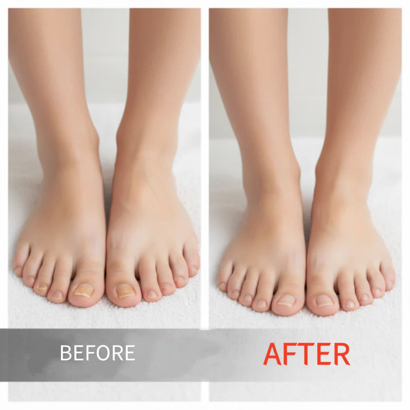 Powerful Toenail Fungus Removal Serum